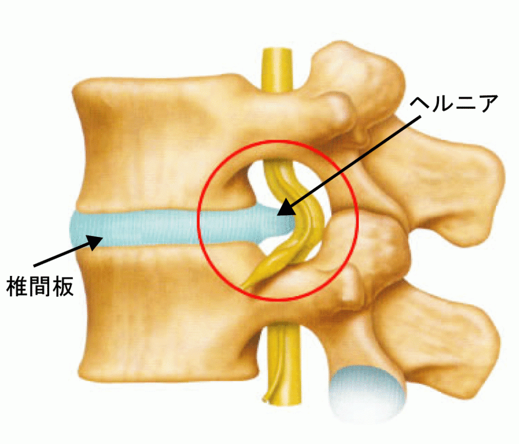 名張市iroha整骨院スポーツジム～腰痛　ヘルニア～