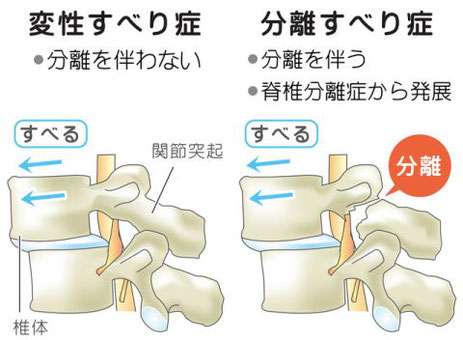 名張市iroha整骨院スポーツジム～腰痛　すべり症～