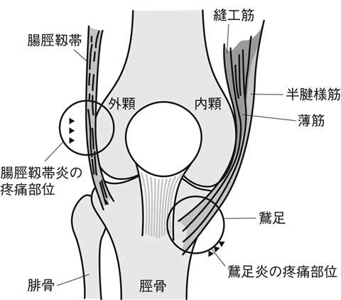 名張市iroha整骨院スポーツジム～膝の内側の痛み　鵞足炎～