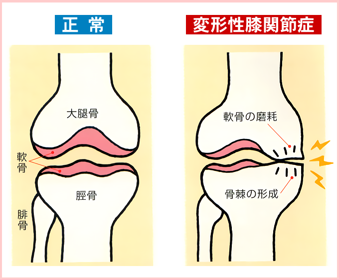 名張市iroha整骨院スポーツジム～膝の内側の痛み　変形性膝関節症～