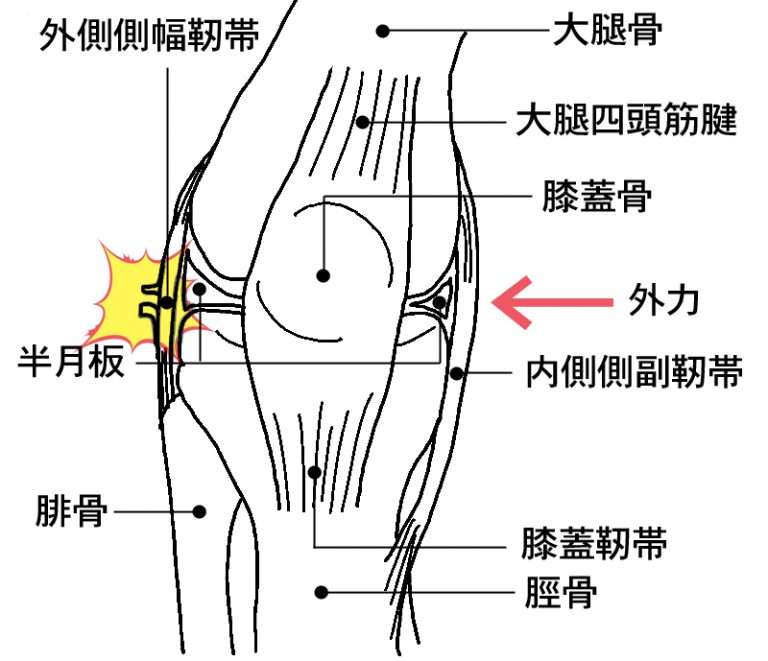 名張市iroha整骨院スポーツジム～外側の膝の痛み　外側側副靭帯損傷～