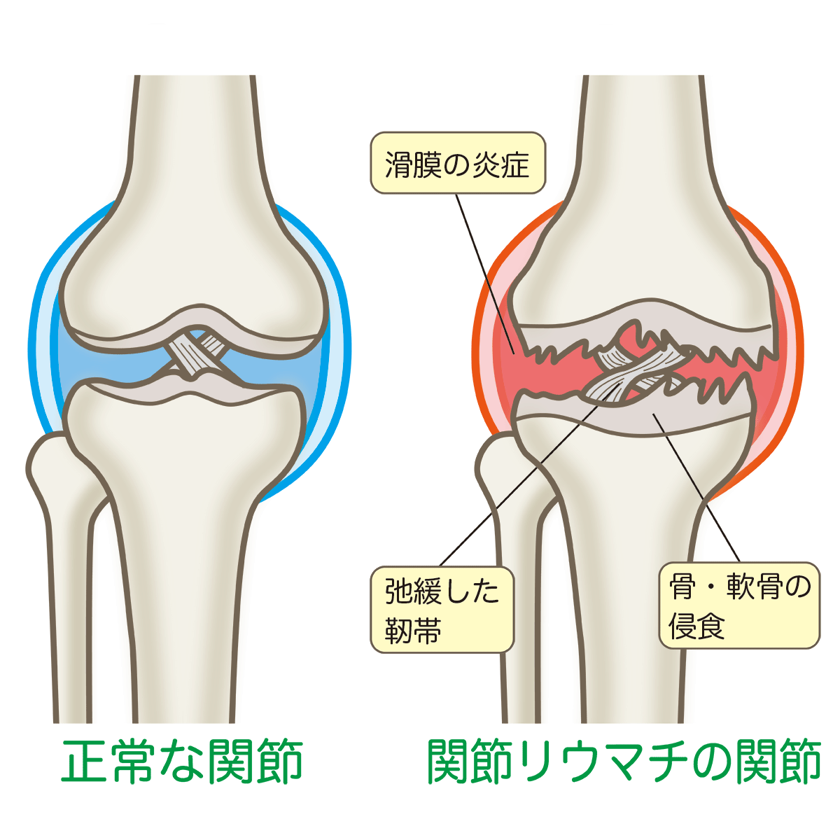 名張市iroha整骨院スポーツジム～膝の裏側の痛み　関節リウマチ～